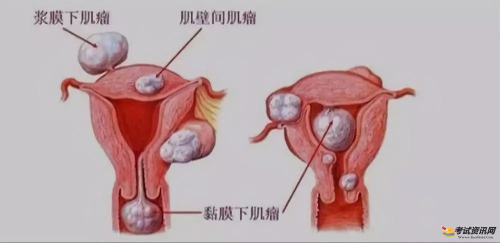 子宫肌瘤是什么?女人宫颈炎不能吃的食品有?
